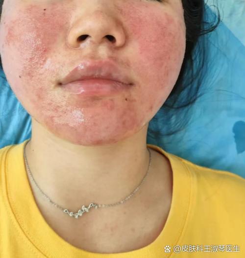 护肤品擦脸辣辣的是怎么回事？-图2