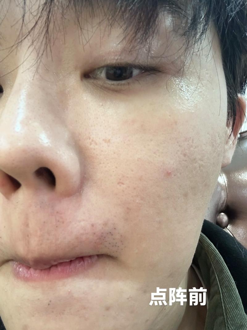 激光祛痘后悔？是坑还是没选对？-图2