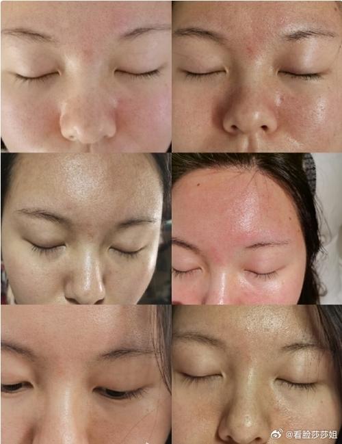 激光祛痘后悔？是坑还是没选对？-图3