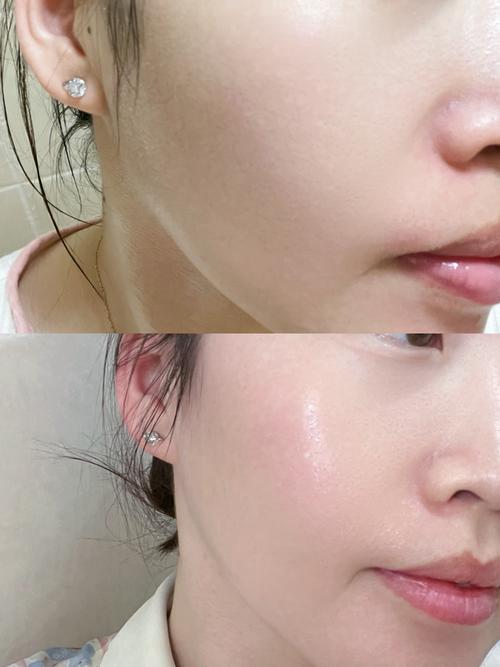 祛痘面膜该敷多久？什么时候敷最好？-图3