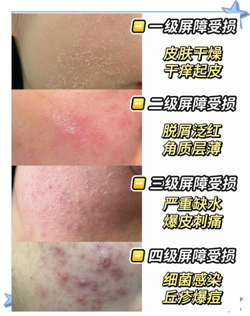 脸蜕皮，用什么护肤品修复好？-图3