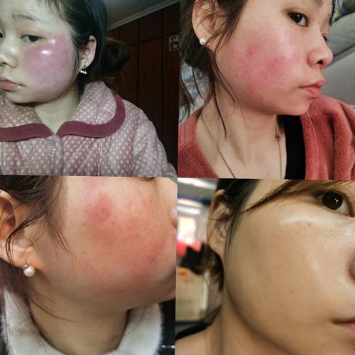 脸过敏可以涂护肤品吗-图2