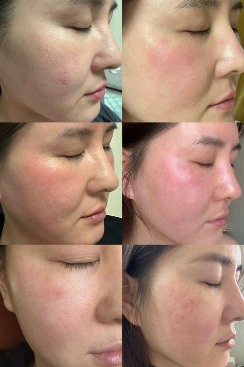 脸过敏可以涂护肤品吗-图3