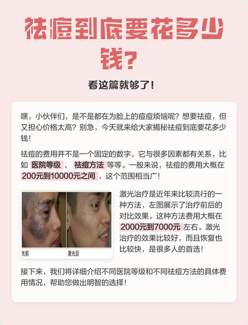 正规医院激光祛痘一般多少钱？-图1