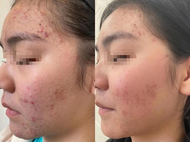 活动面部肌肉真能祛痘吗？-图1