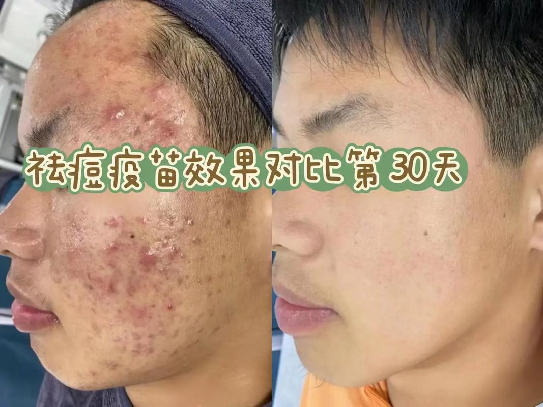 活动面部肌肉真能祛痘吗？-图2