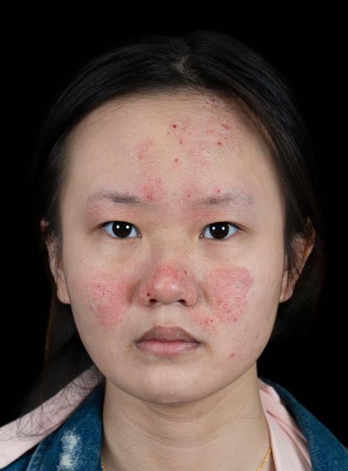 IPL复合彩光祛痘印效果如何?-图1 IPL复合彩光祛痘印效果如何?-图1