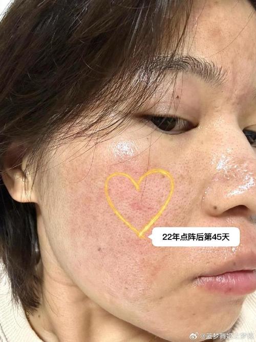 IPL复合彩光祛痘印效果如何?-图3 IPL复合彩光祛痘印效果如何?-图3