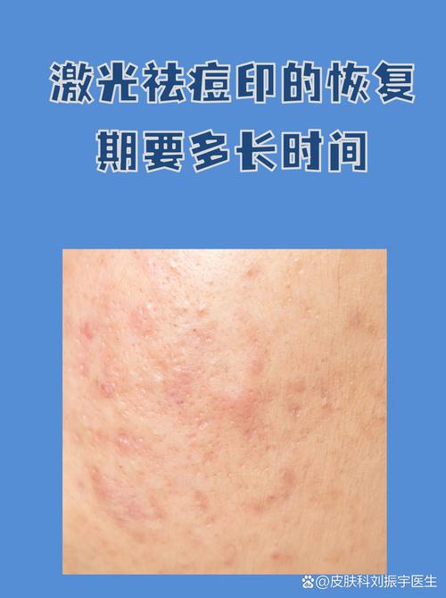 北京激光祛痘哪家医院最靠谱？-图1