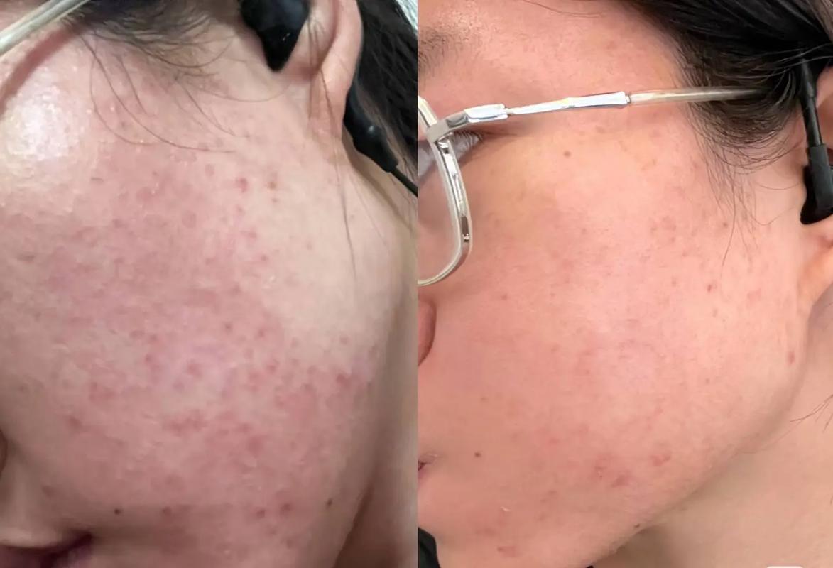 薰衣草祛痘搭配什么效果更好?-图3 薰衣草祛痘搭配什么效果更好?-图3