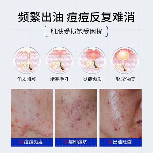 日本面膜控油祛痘效果真的好吗？-图3