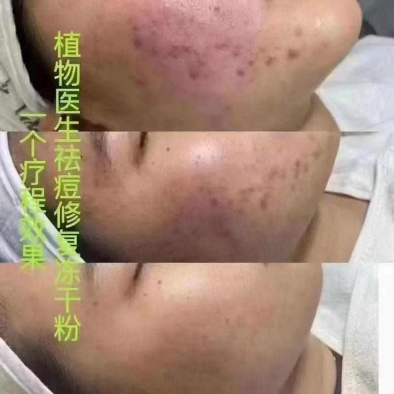 植物医生哪个系列祛痘好？-图2