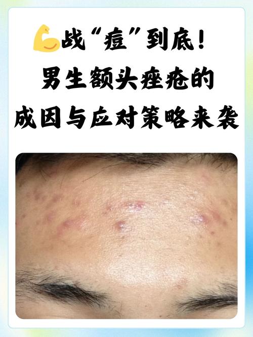 男生如何快速祛痘粉刺?-图2 男生如何快速祛痘粉刺?-图2