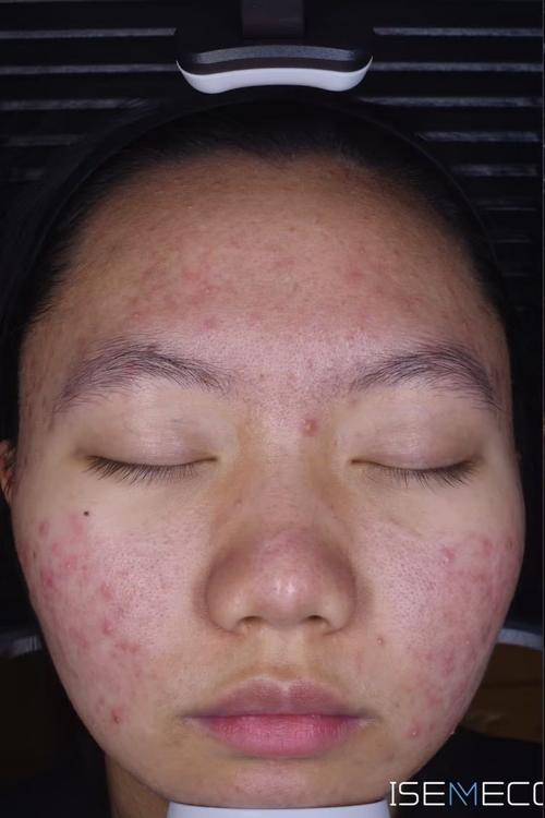 激光祛痘几天能恢复？-图2