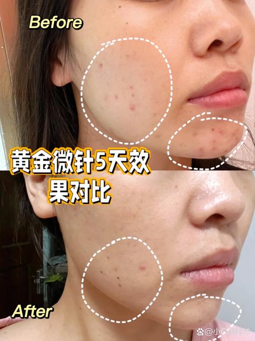 钻石微雕祛痘真能彻底根除吗？-图2
