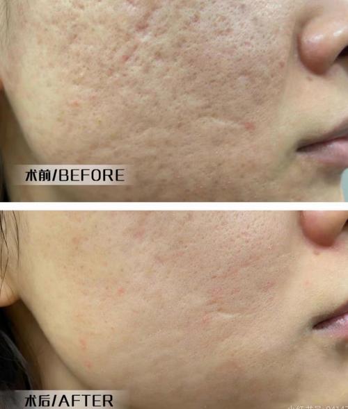 钻石微雕祛痘真能彻底根除吗?-图3 钻石微雕祛痘真能彻底根除吗?-图3