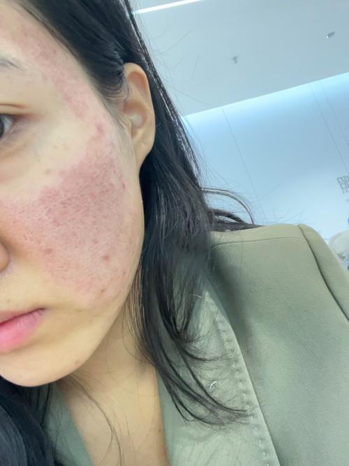 激光祛痘过程到底有多可怕?-图1 激光祛痘过程到底有多可怕?-图1