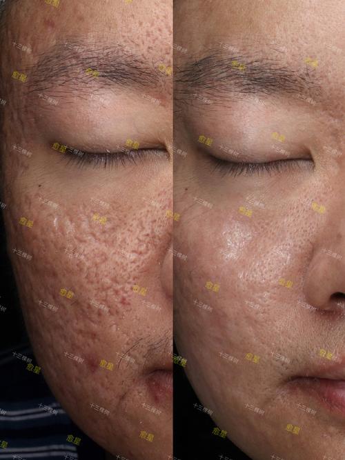 激光祛痘过程到底有多可怕?-图2 激光祛痘过程到底有多可怕?-图2