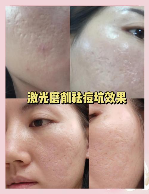 激光祛痘过程到底有多可怕?-图3 激光祛痘过程到底有多可怕?-图3