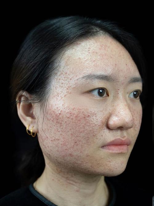 激光祛痘后多久才能正常洗脸？-图3