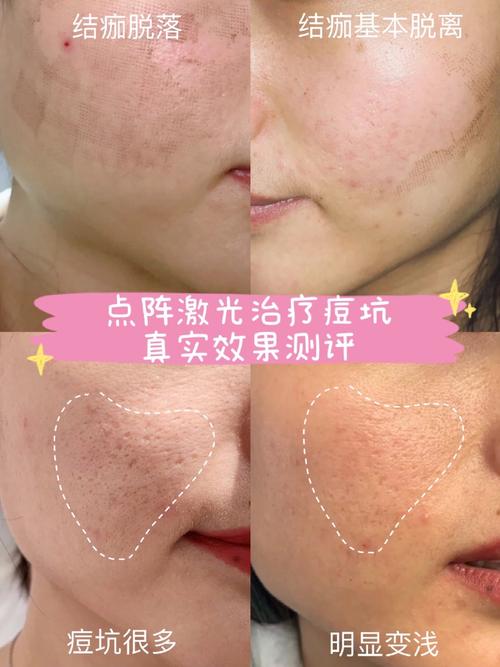 激光祛痘效果到底好不好？-图1