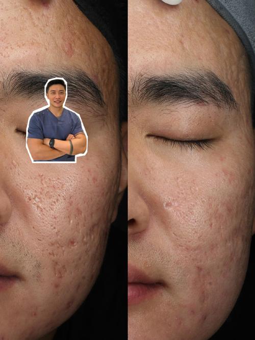 激光祛痘效果到底好不好？-图2