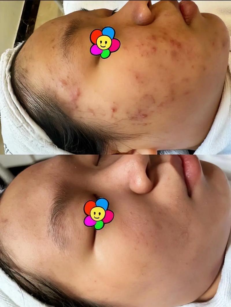 手机修视频软件真能祛痘吗？-图3