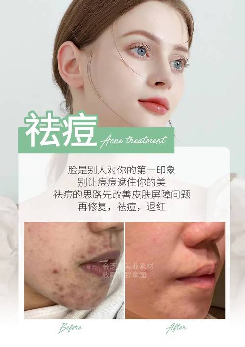 保定祛痘祛痘印一般要花多少钱？-图1