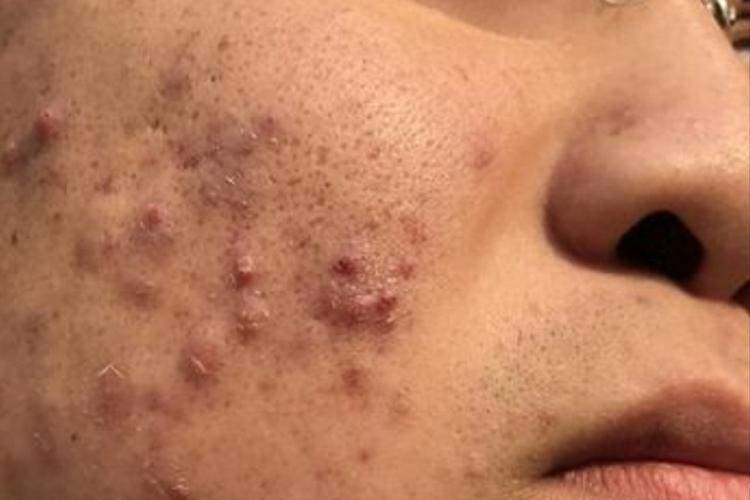 保定祛痘祛痘印一般要花多少钱？-图2