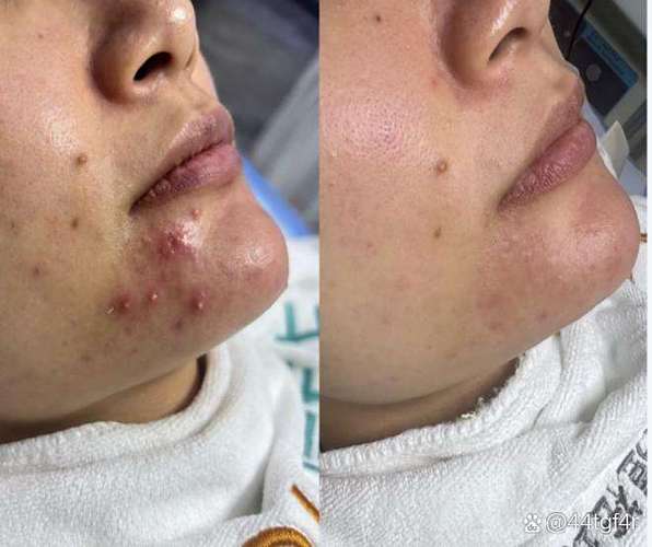 祛痘洗面奶反而爆痘？-图1