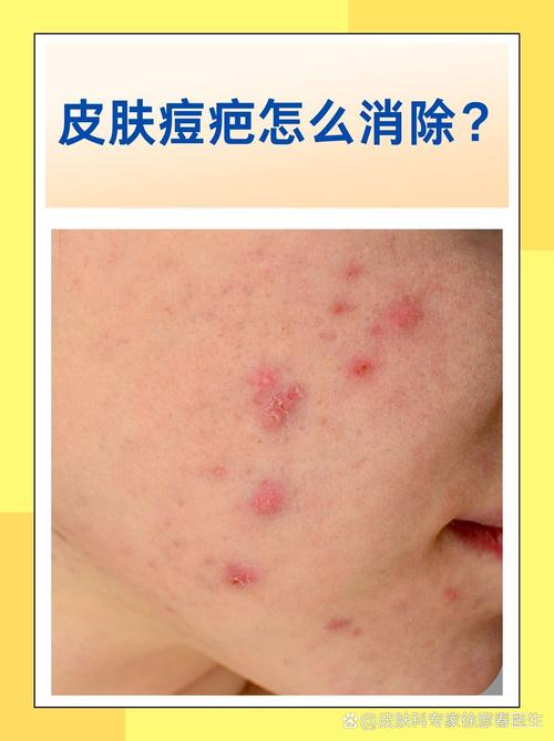 祛痘印痘疤最有效果的-图1