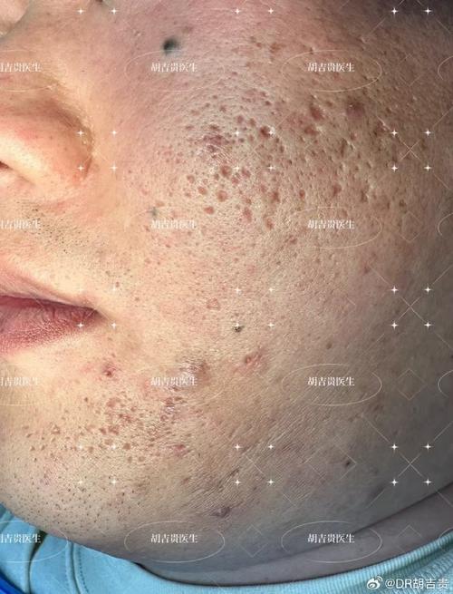 祛痘印痘疤最有效果的-图2