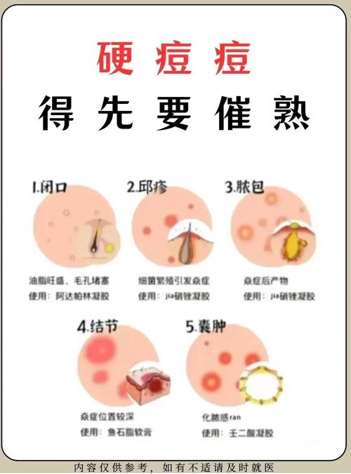 祛痘机构先挤痘有用吗-图1 祛痘机构先挤痘有用吗-图1