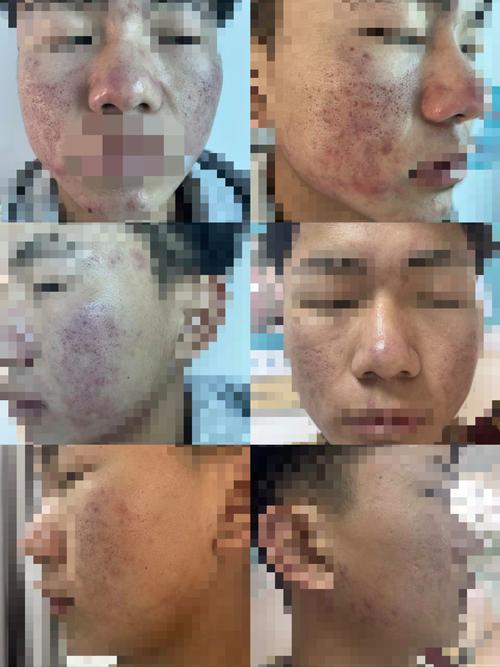 激光祛痘印痘坑真的有效吗？-图2