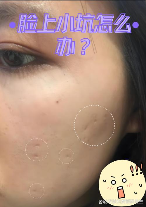 祛痘印痘坑凹洞视频真的能去吗?-图1 祛痘印痘坑凹洞视频真的能去吗?-图1