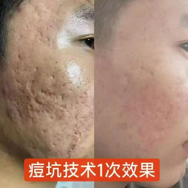 祛痘印痘坑凹洞视频真的能去吗?-图2 祛痘印痘坑凹洞视频真的能去吗?-图2