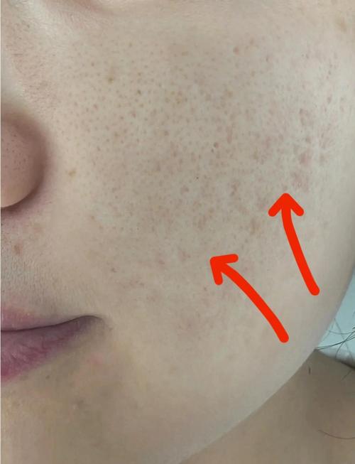 祛痘印痘坑凹洞视频真的能去吗?-图3 祛痘印痘坑凹洞视频真的能去吗?-图3