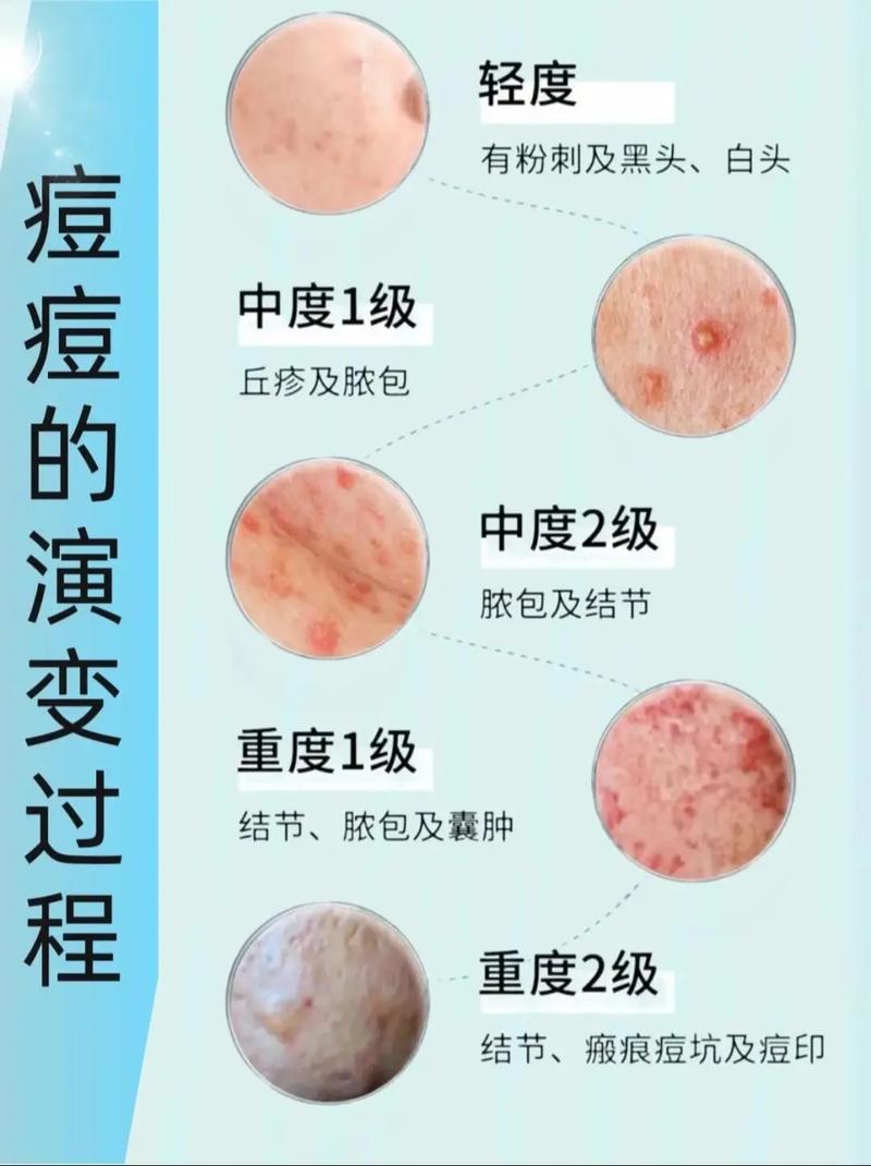 祛痘挤痘是美容院好选择吗？-图2