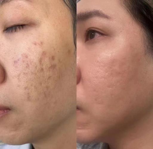 祛痘印和祛斑,哪个更难搞定?-图2 祛痘印和祛斑,哪个更难搞定?-图2