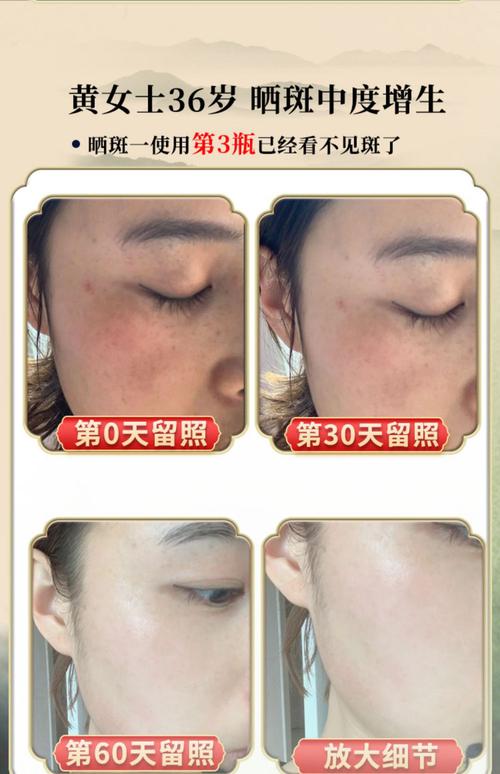 祛痘印和祛斑,哪个更难搞定?-图3 祛痘印和祛斑,哪个更难搞定?-图3