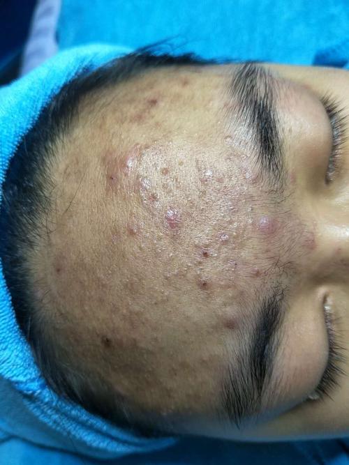 青春期祛痘 痘坑哪最-图1