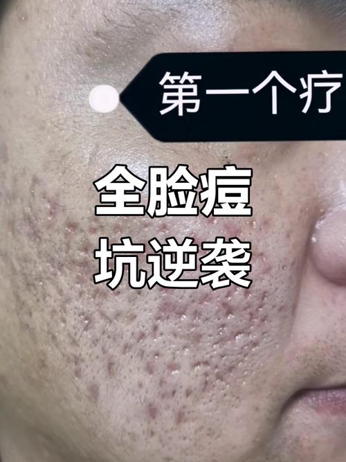 青春期祛痘 痘坑哪最-图2