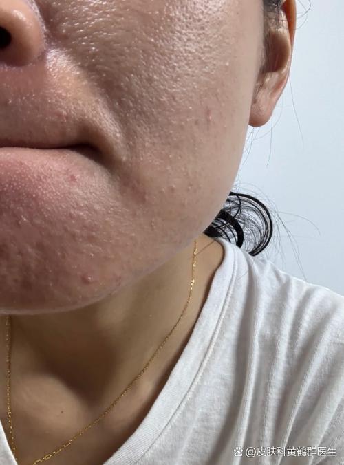 护肤品用后起小米粒疙瘩是过敏吗?-图1 护肤品用后起小米粒疙瘩是过敏吗?-图1