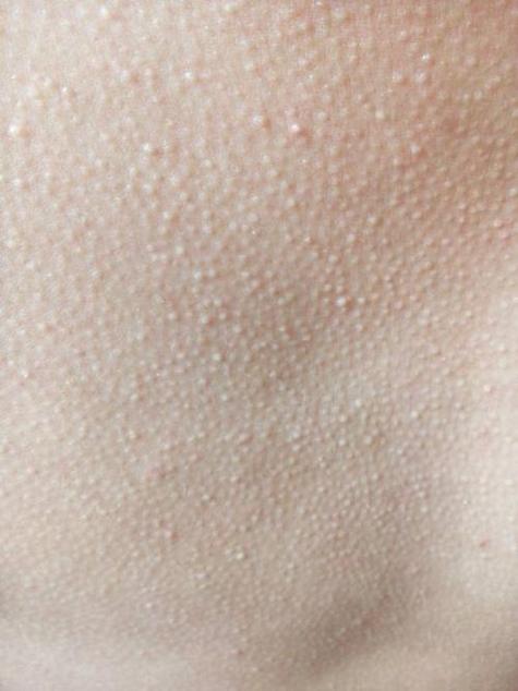 护肤品用后起小米粒疙瘩是过敏吗？-图2