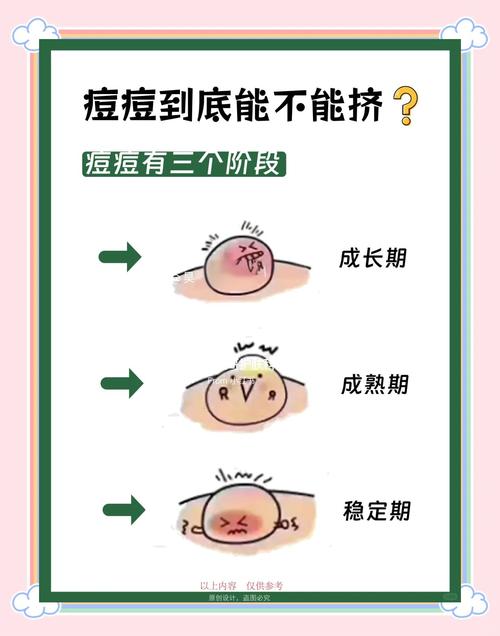 手挤痘安全吗?专业祛痘也需谨慎?-图1 手挤痘安全吗?专业祛痘也需谨慎?-图1