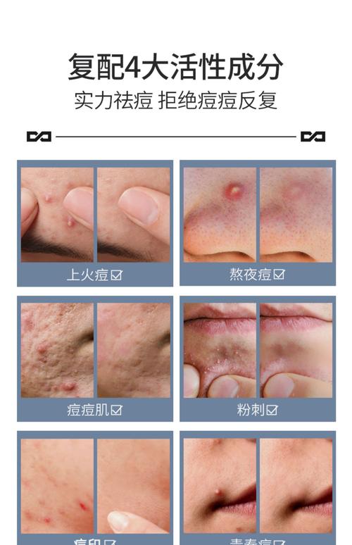 祛痘补水保湿美白痘印，怎么兼顾才有效？-图1