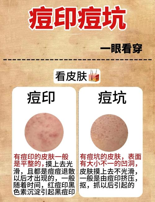 祛痘祛印用什么好？-图1