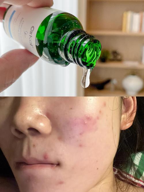 Cici小黑瓶 祛痘-图1 Cici小黑瓶 祛痘-图1