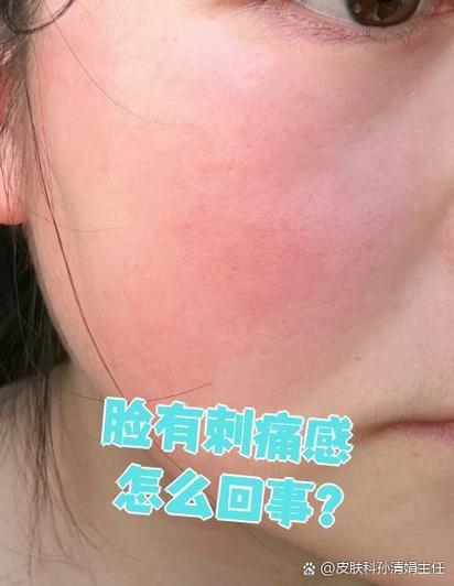 护肤品上脸刺痛是过敏了吗?-图3 护肤品上脸刺痛是过敏了吗?-图3