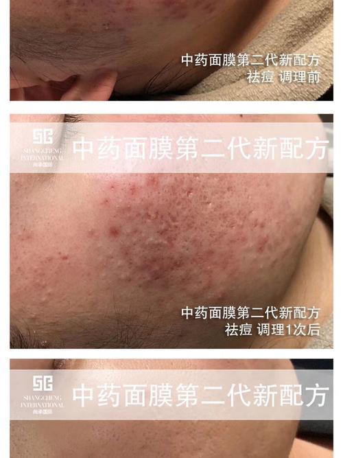 祛斑祛痘该选什么护肤品?-图3 祛斑祛痘该选什么护肤品?-图3